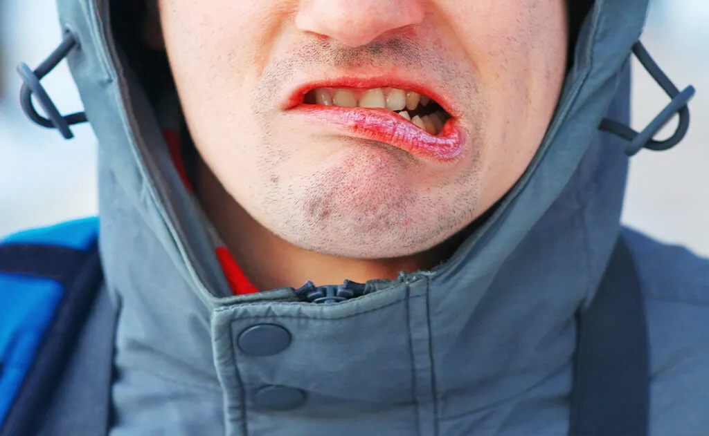 Cracked dry lips of man's face. The man's face contorts in pain dry mouth and skin. Care for chapped lips in the cold season. Concept of a healthy lifestyle.